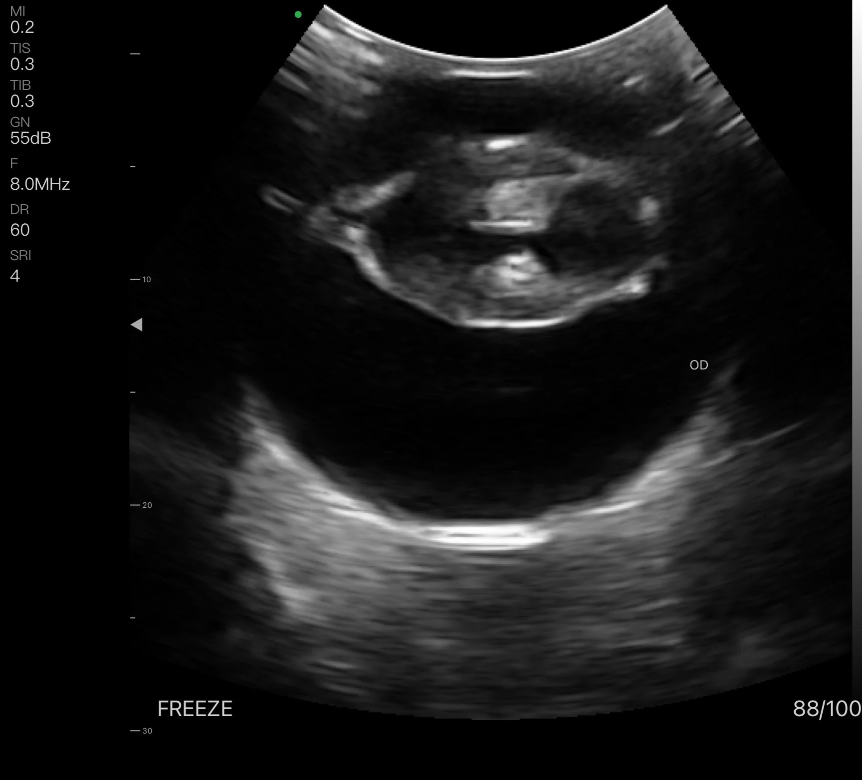 Cataractous lens.jpg