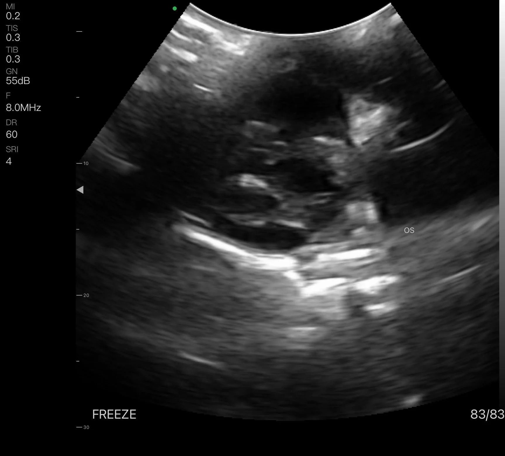 Avulsed pecten with retinal detachment.jpg