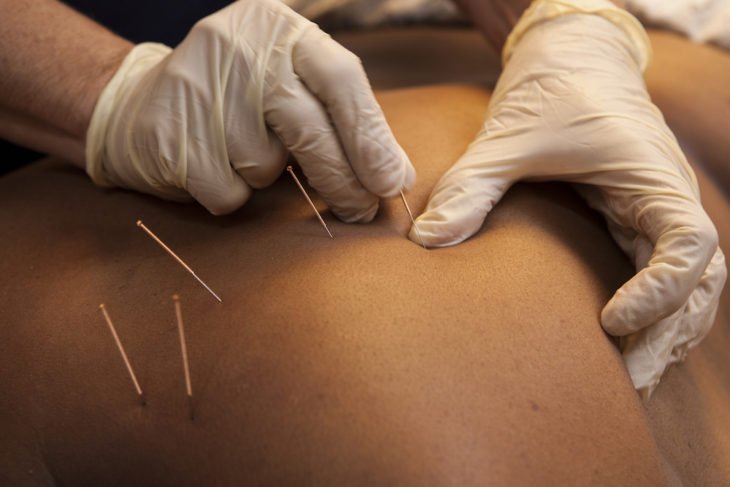 Dry Needling Therapy: A Modern Panacea for Chronic Pain and Muscle Tension