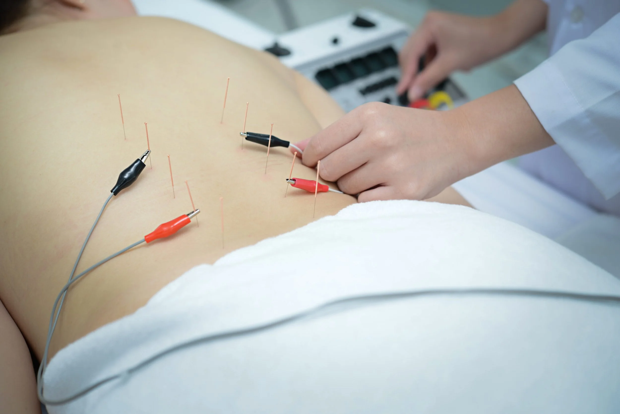 acupuncture and electrical stimulation on low back