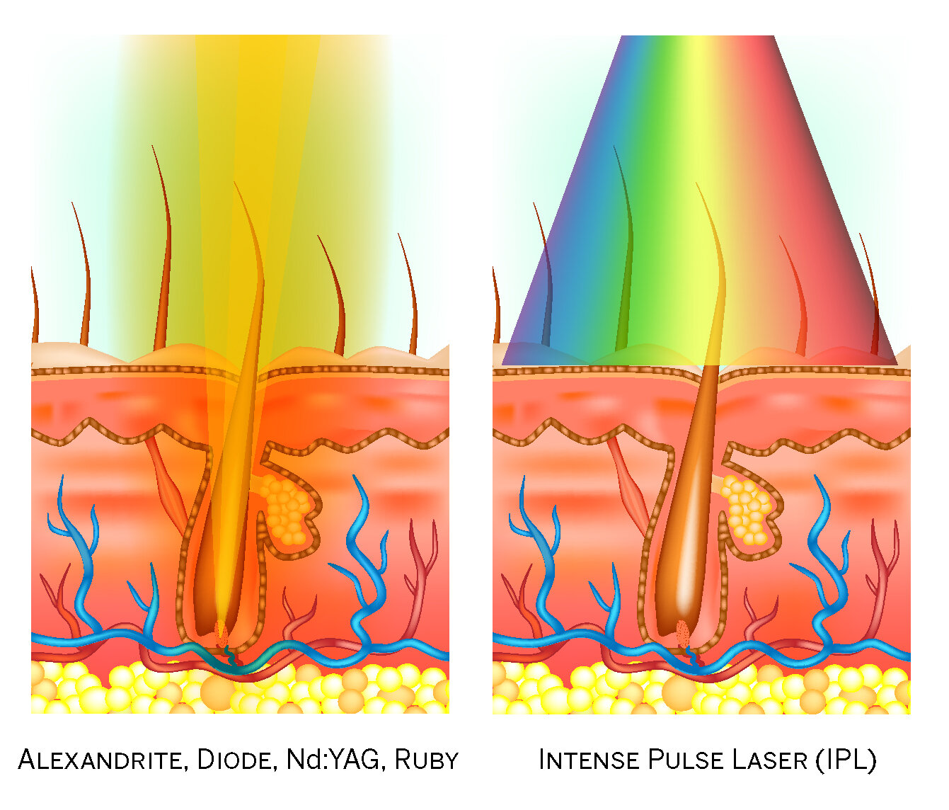 Laser Hair Removal Versus Electrolysis Hair Removal Electrolysis Beauty Lounge