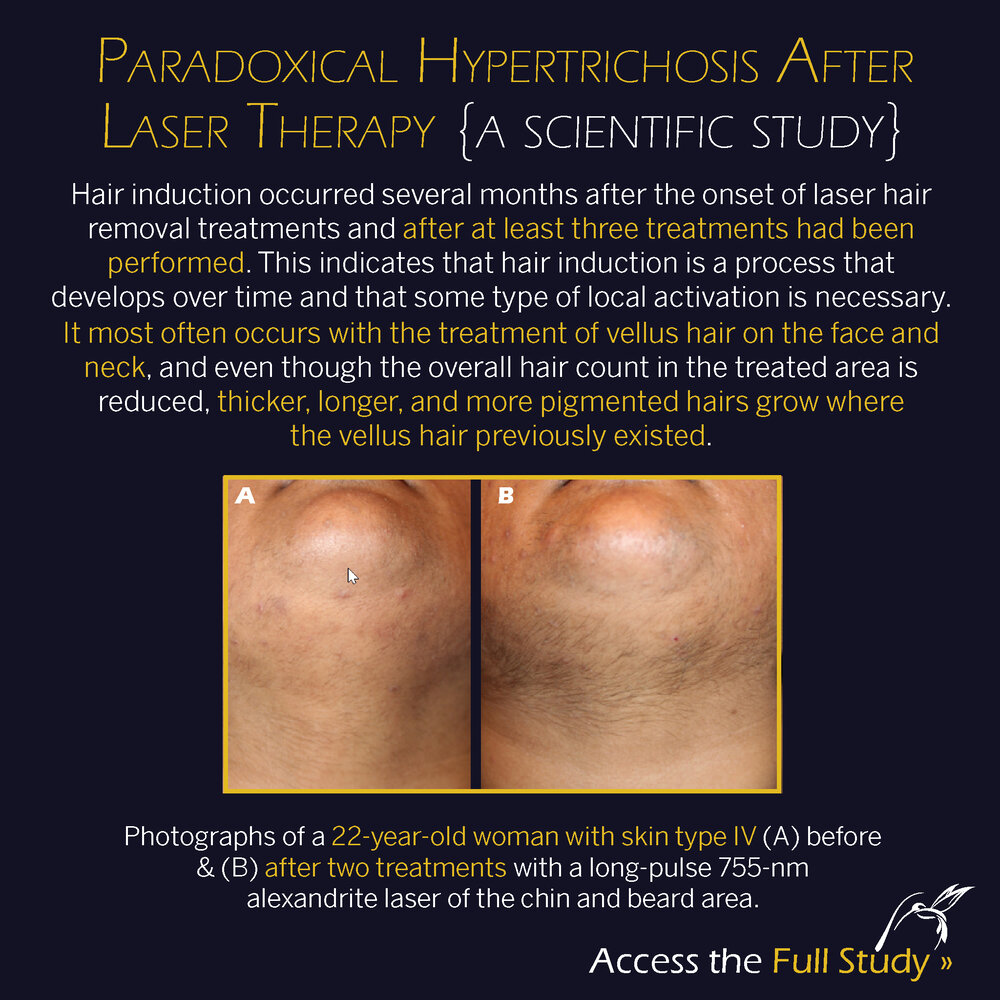 Paradoxical Hypertrichosis After Laser Therapy A Review