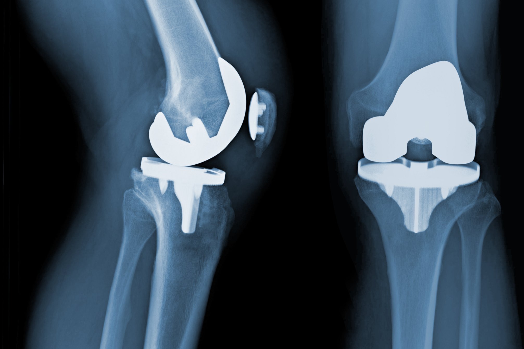 Arthrose Kniegelenk - künstliches Gelenk
