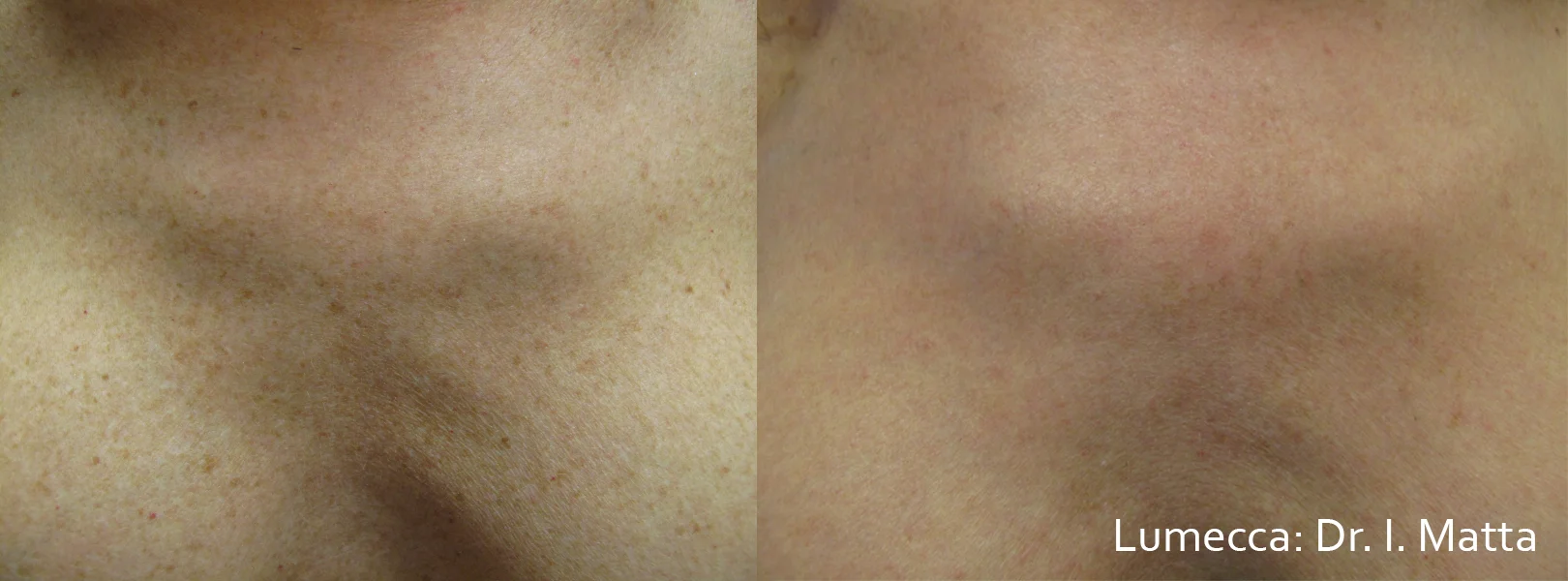 IM_Lumecca_1a_1tx_515_17jcm_1pass1.jpg