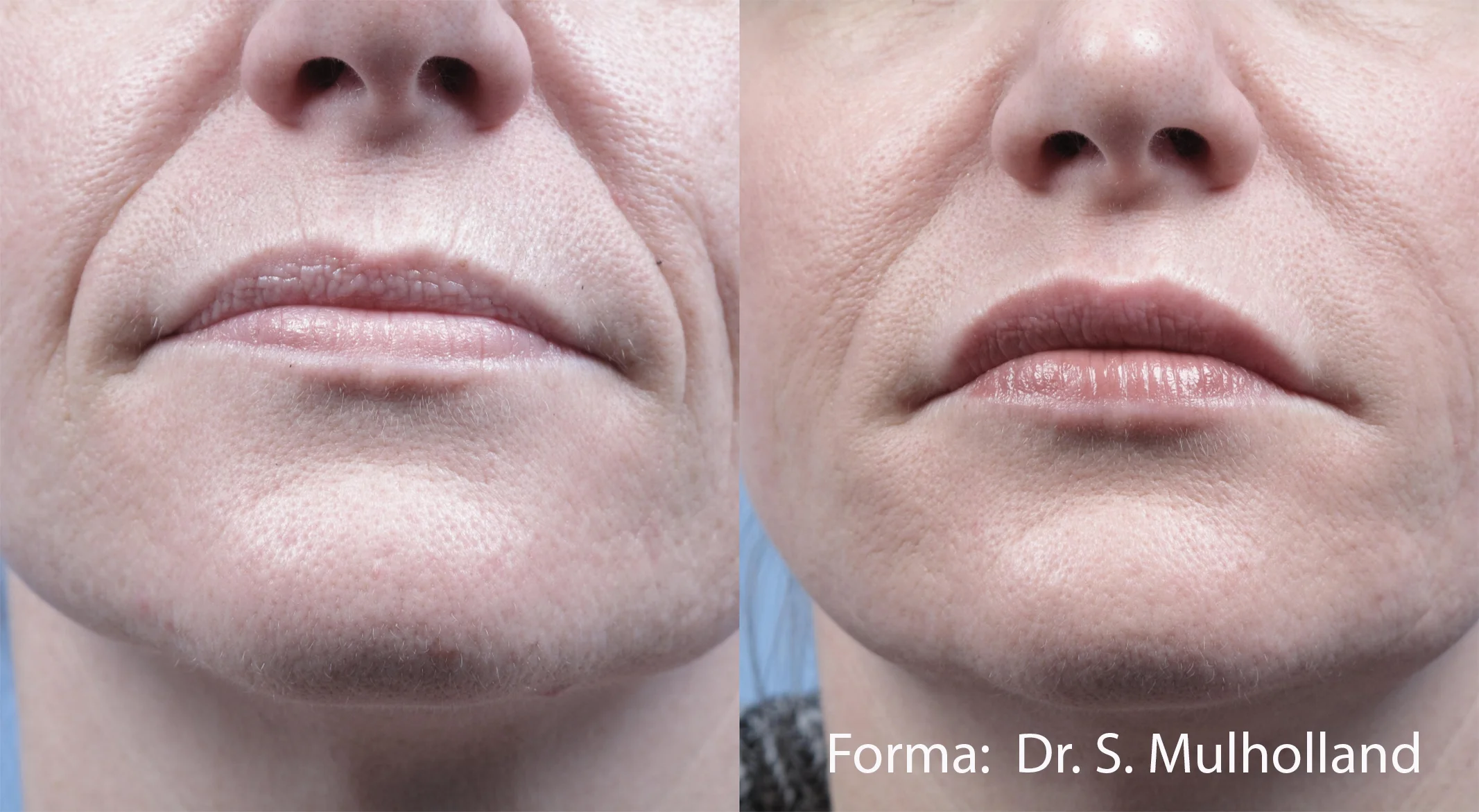 SM_Forma_2a_FT_Face.jpg