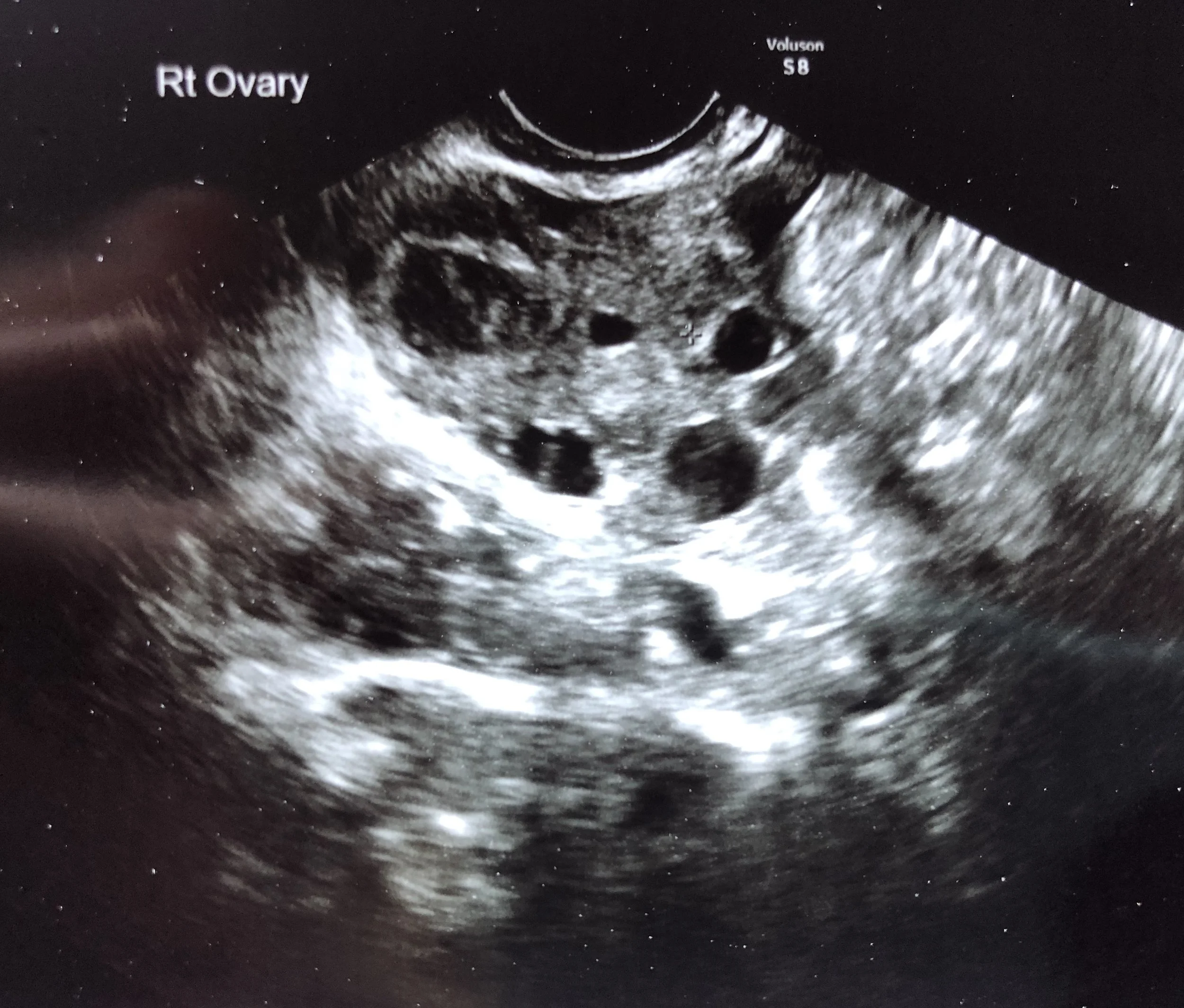 Polycystic Ovary Syndrome