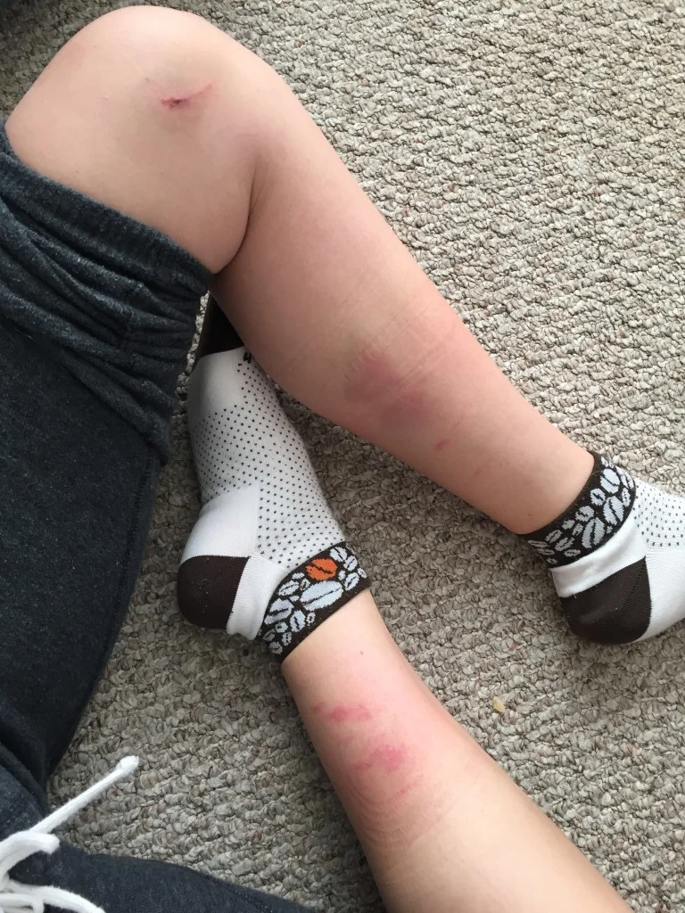 Tight switchback turns and a fall at the start of Saturday's race had me all beat up.