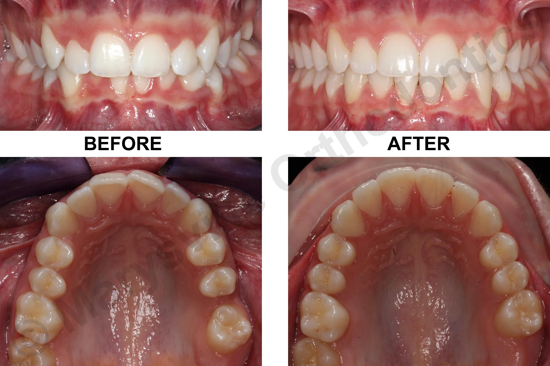 MISSING LEFT PERMANENT FIRST MOLAR