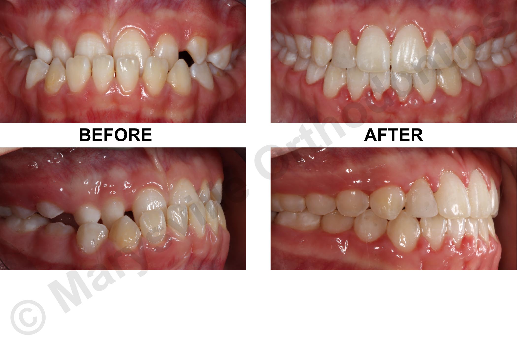 UNDERBITE, IMPACTED UPPER RIGHT CANINE AND UNDERSIZED UPPER RIGHT LATERAL INCISOR
