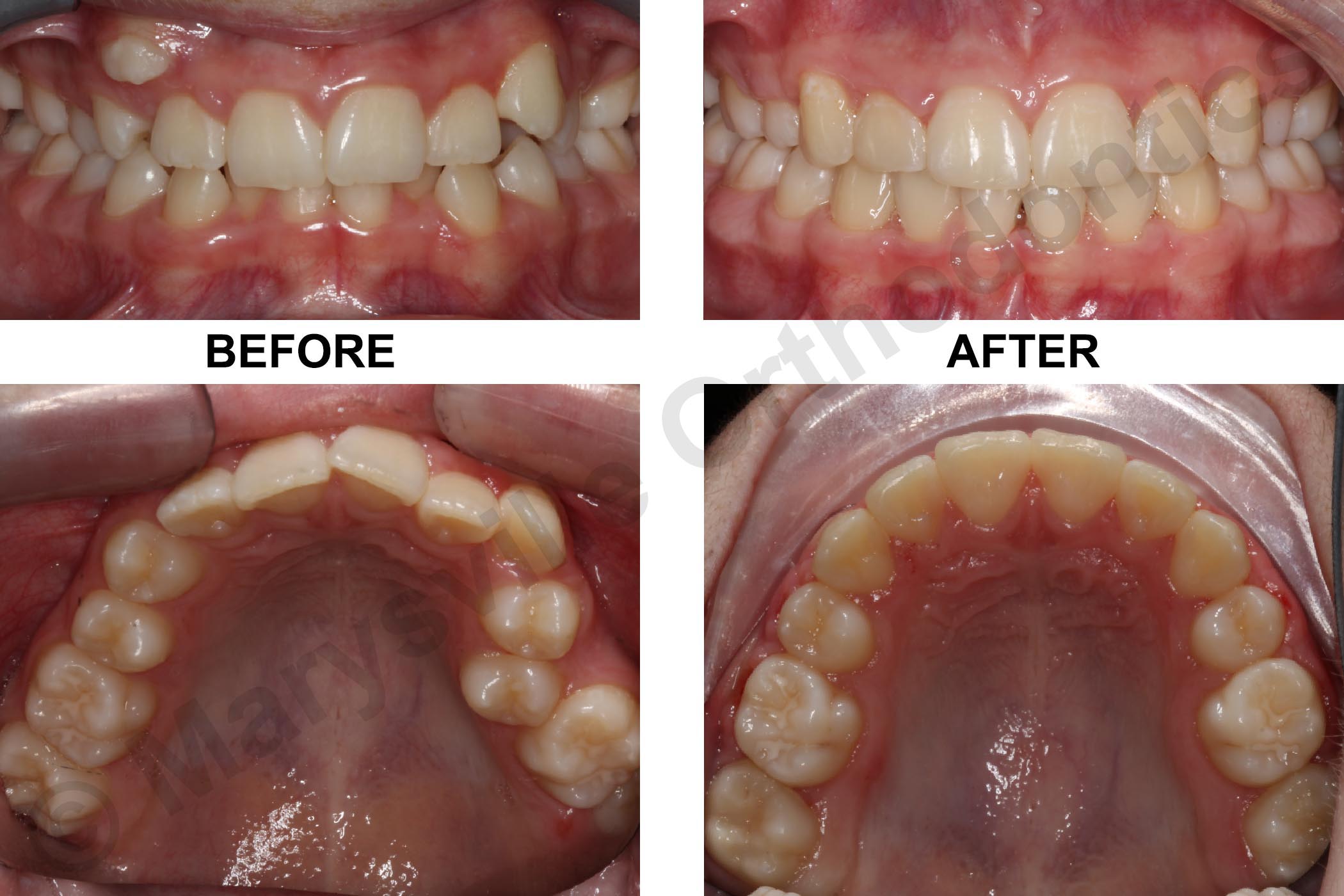 SEVERE CROWDING, OVERJET AND DISPLACED UPPER RIGHT CANINE