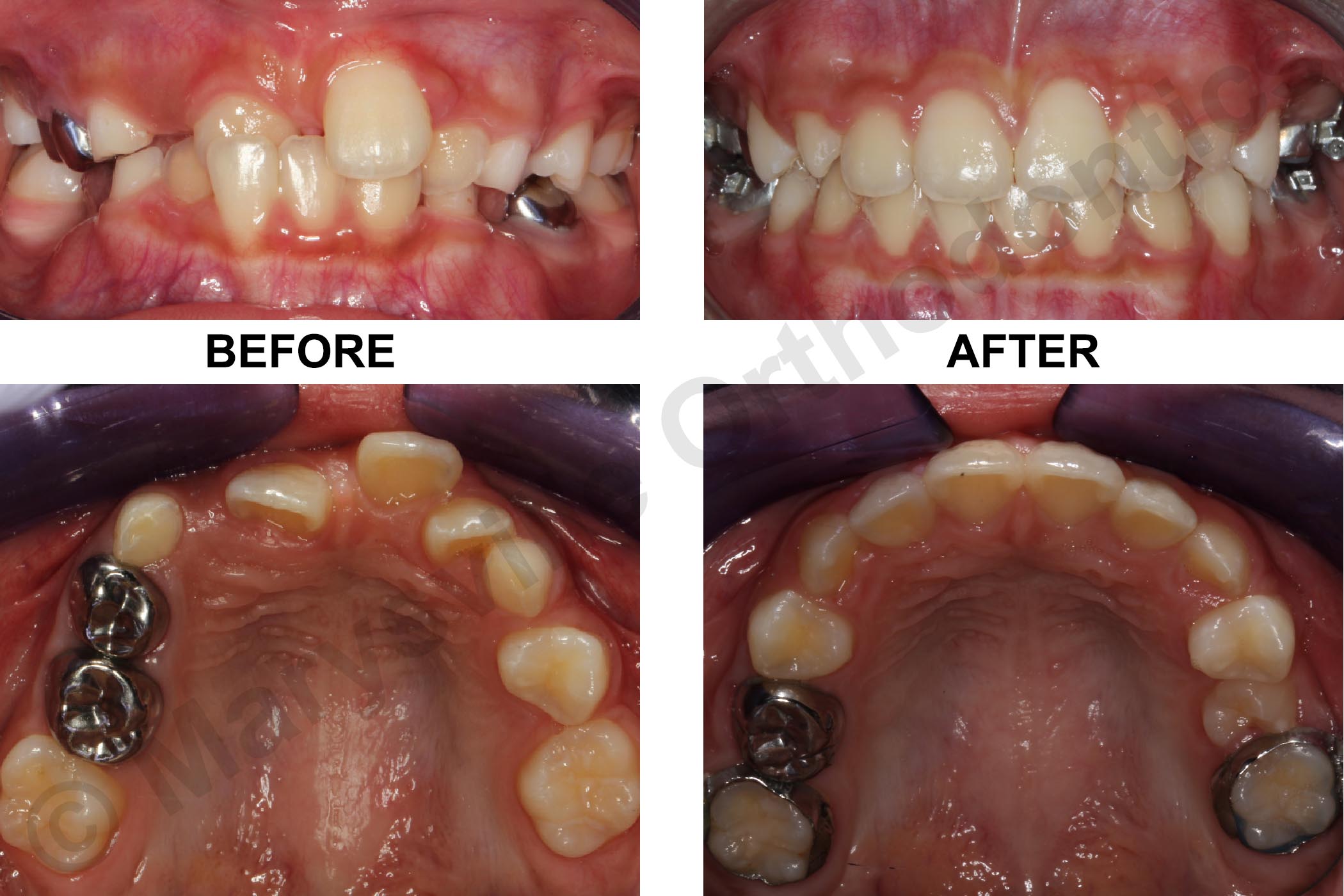EARLY TREATMENT OF ANTERIOR CROSSBITE AND SPACE MANAGEMENT