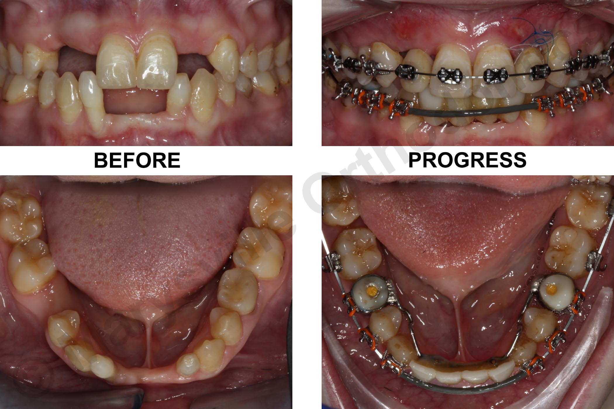 MULTIPLE MISSING TEETH AND RETAINED BABY TEETH