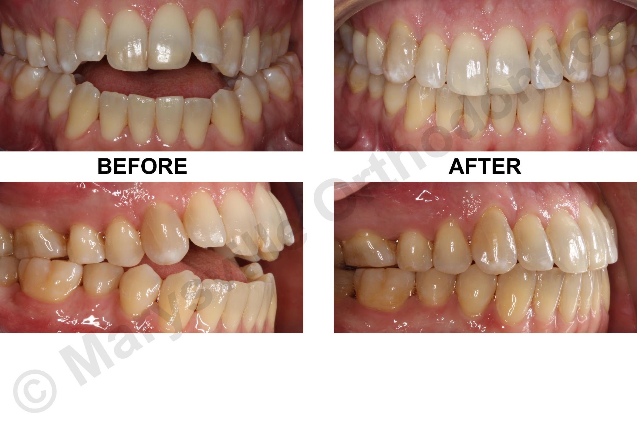 POSTERIOR CROSSBITE AND ANTERIOR OPENBITE