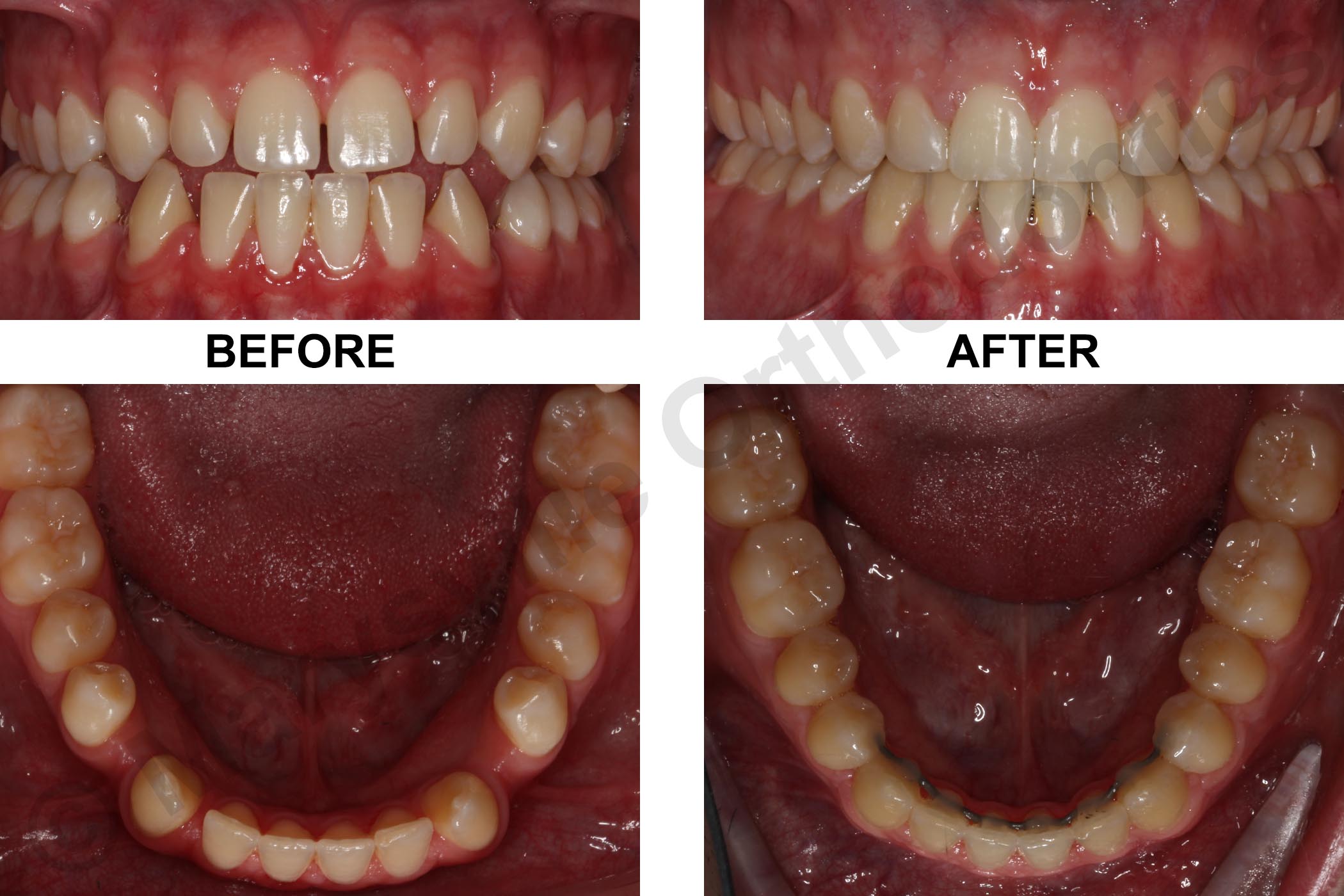 SPACING, TONGUE THRUST, POSTERIOR CROSSBITE AND ANTERIOR CROSSBITE