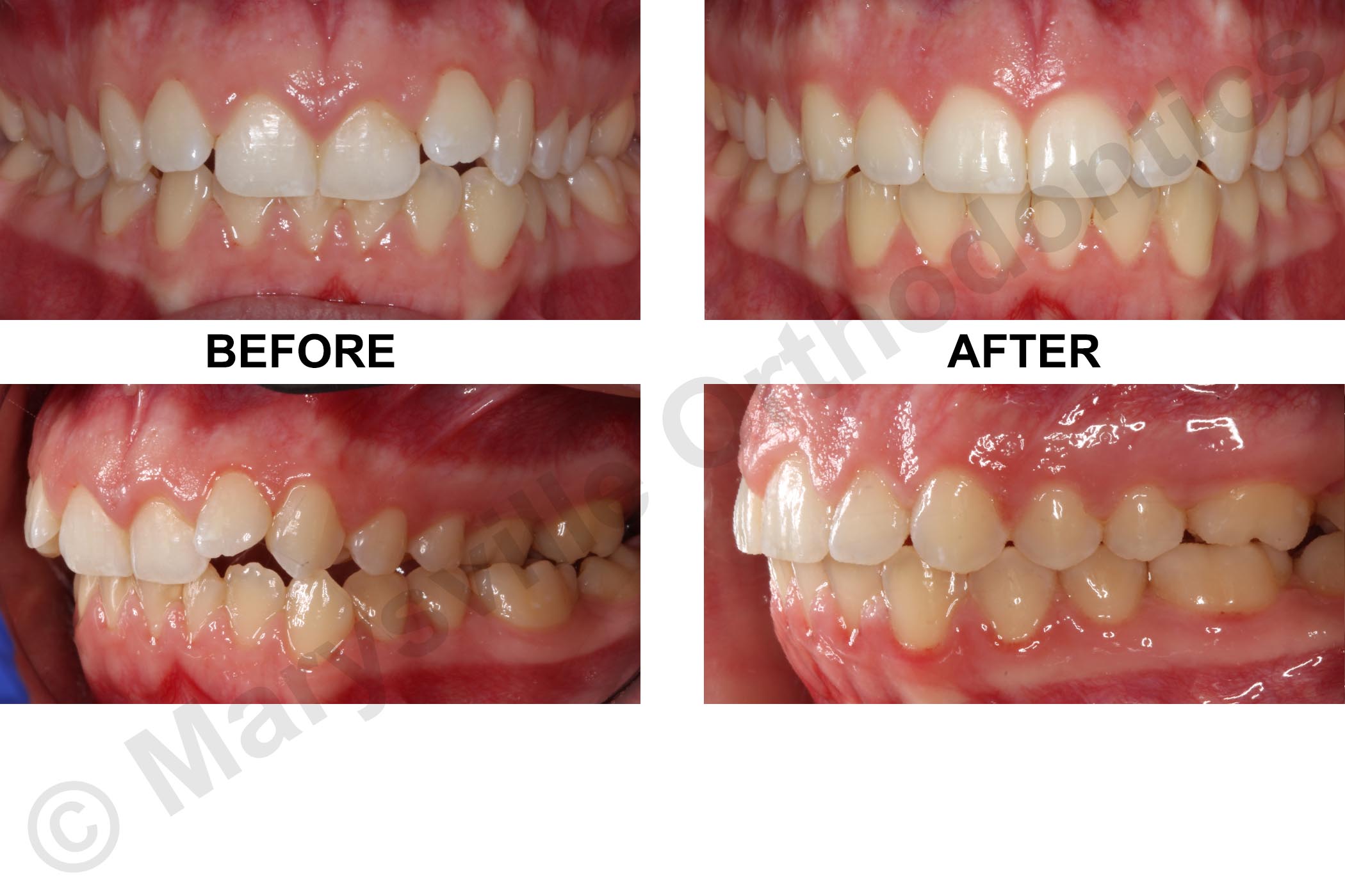 ASYMMETRY, CROWDING, POSTERIOR CROSSBITE AND GUMMY SMILE