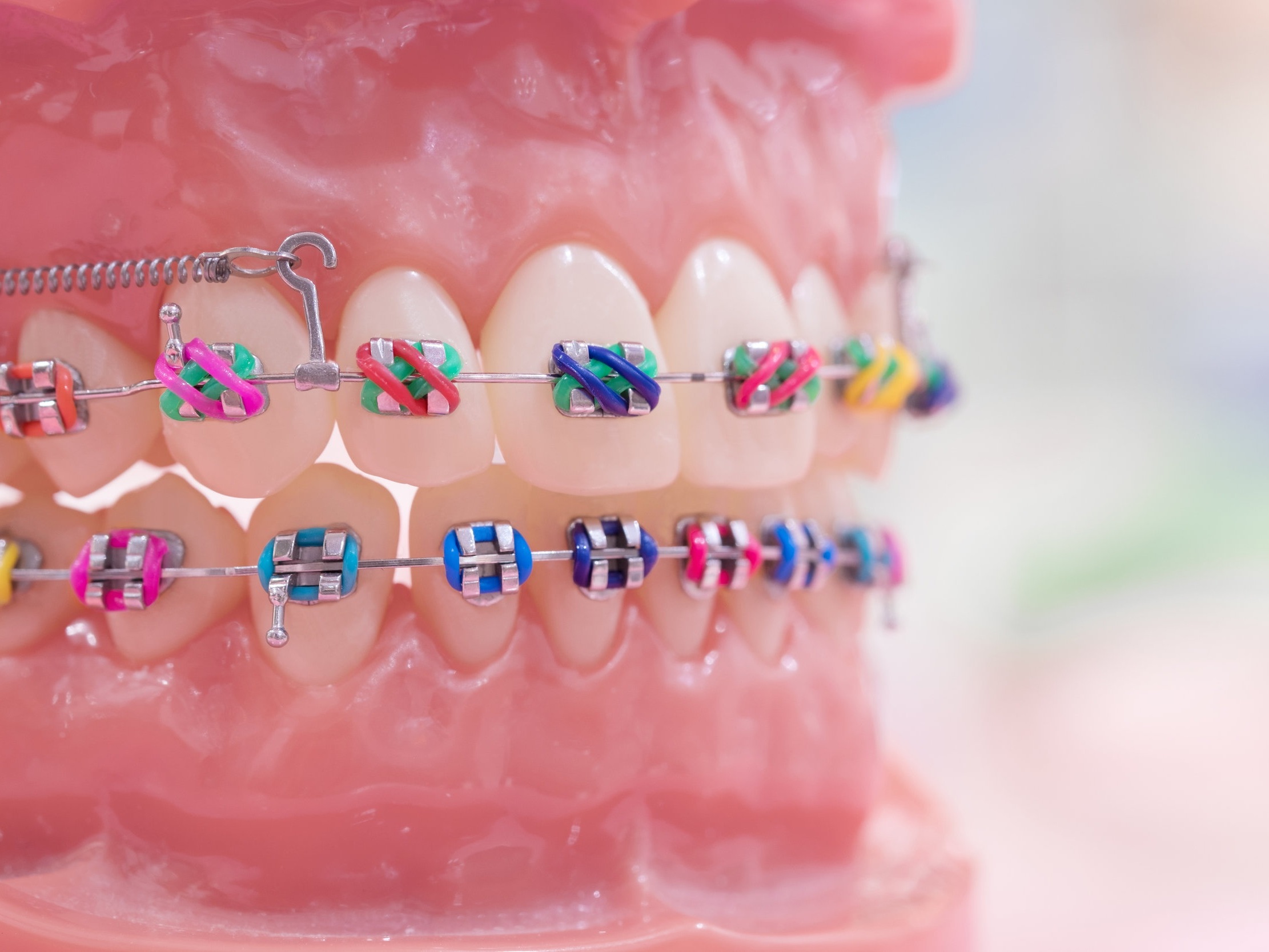 Learning the Basics About Rubber Bands on Braces