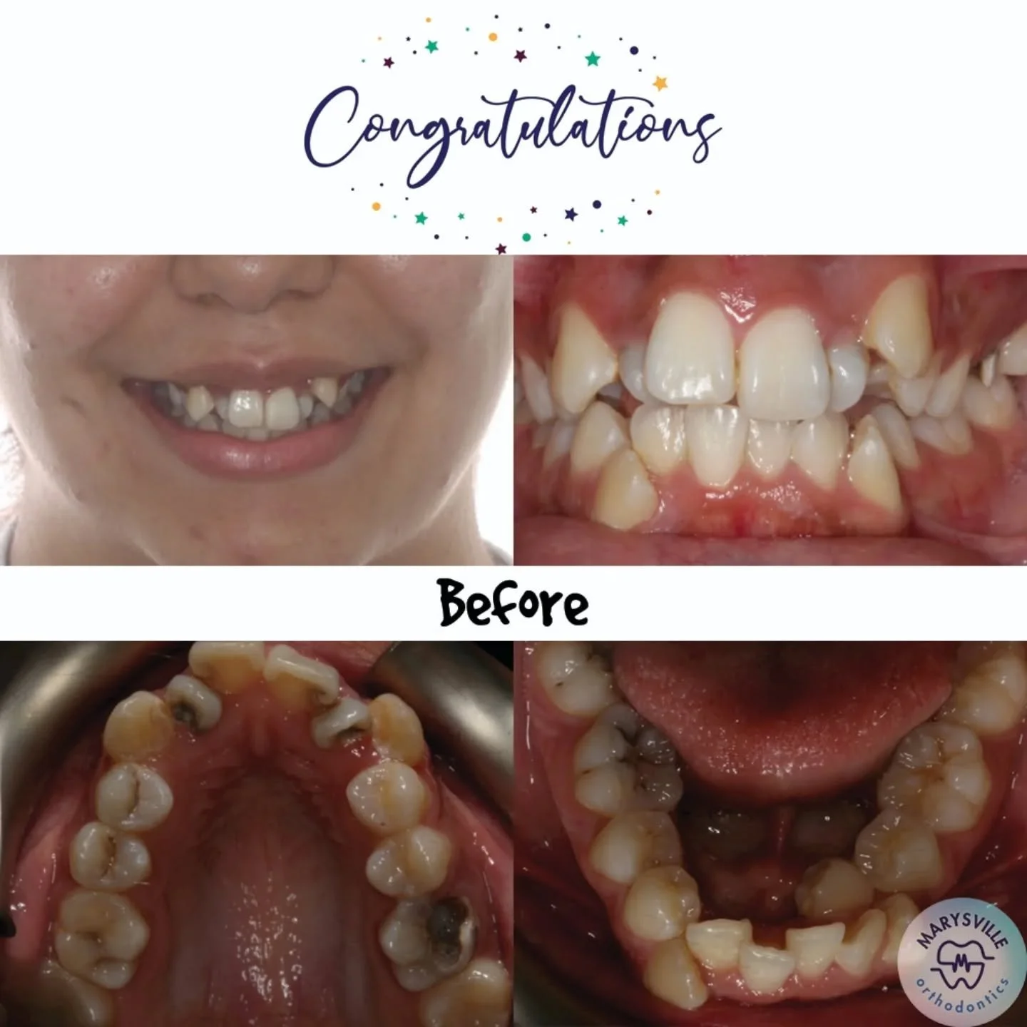 ✨ Another Amazing Smile Transformation at Marysville Orthodontics! ✨

Samantha came to us three years ago with concerns about crowding and cavities. Unfortunately, three of her teeth couldn&rsquo;t be saved, but with the collaboration of her dentist 