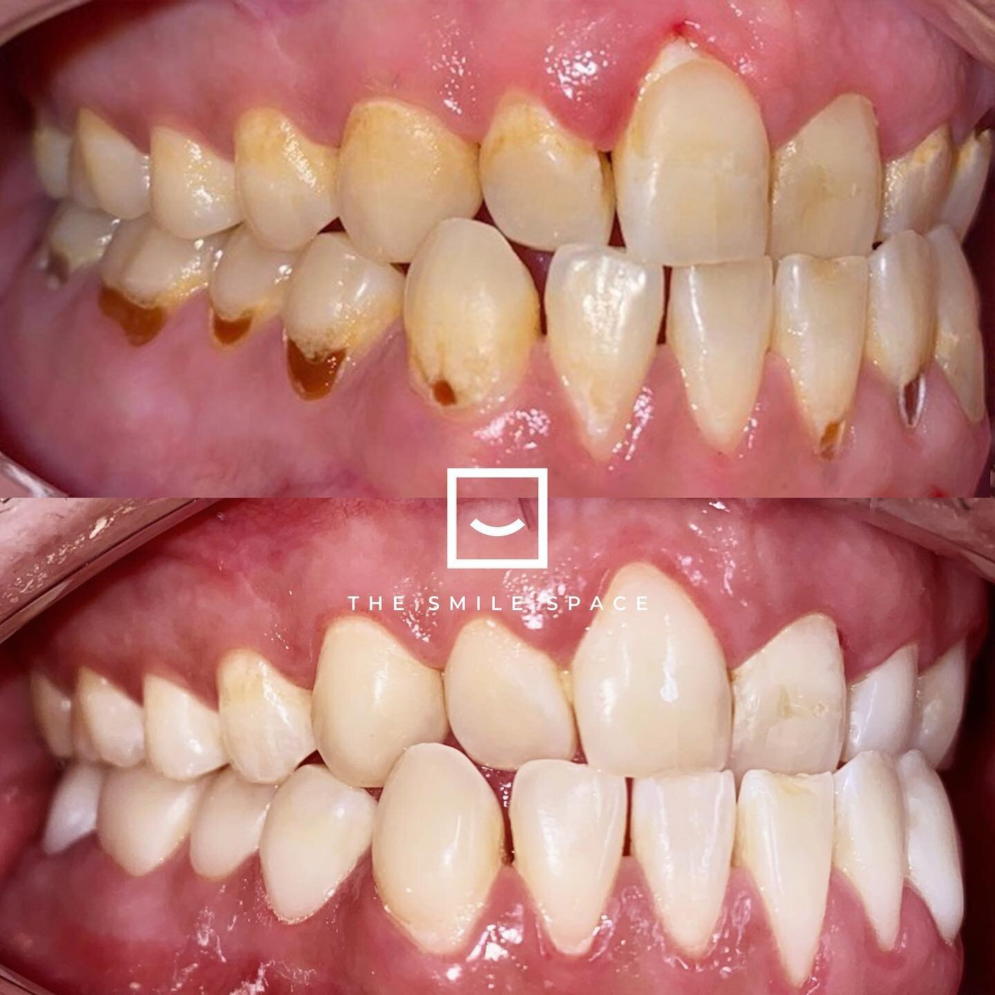This patient thought his teeth were a lost cause, but Dr. Daniel was able to rejuvenate his smile with beautiful #classv #composite #fillings. 

#seattledentist #cavities #belltowndentist #dentist #3msoflex #dentistry #orthodontics #dentaloffice #com