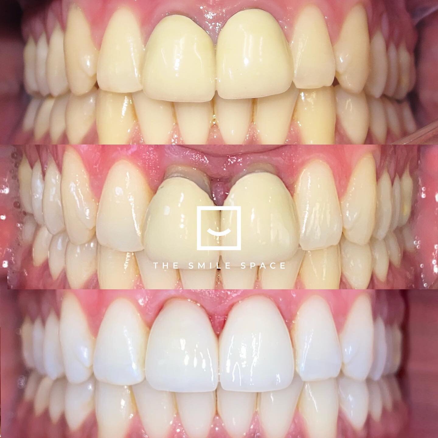 All I want for #Christmas is my two front #teeth. 🎄🎁
Beautiful case of #crownlengthening by Dr. Allen Liu @pugetsoundperiodontics followed by the replacement of old #pfm crowns with new #emax crowns by Dr. Daniel. Amazing lab work by @frontiervenee