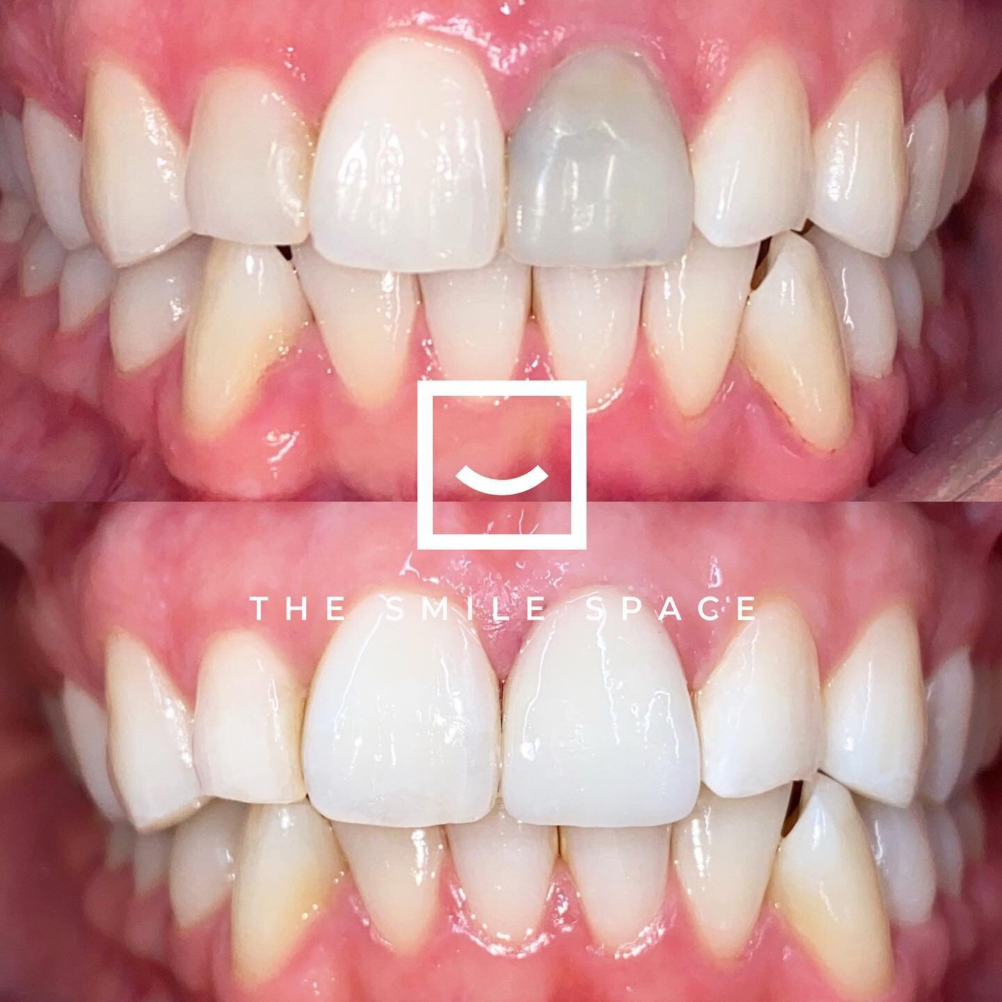 One of the most challenging procedures in #cosmeticdentistry is to restore a #singleunit anterior tooth. It often requires a lot more planning and effort to mimic nature. In this case, our efforts definitely paid off!
.
.
.
#seattledentist #seattleor