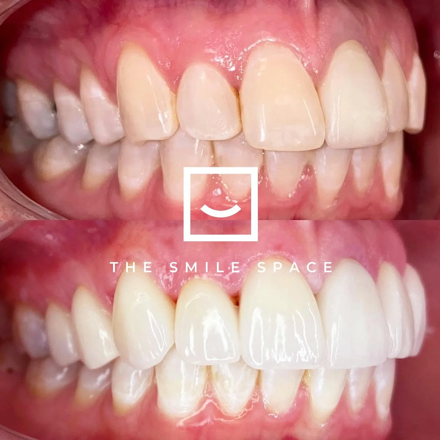 An absolutely beautiful case for a wonderful patient. Dr. Daniel placed 10 upper porcelain veneers to enhance this smile.
.
.
.
#seattledentist #seattleorthodontist #belltowndentist #belltownorthodontist #dentist #orthodontist #dentistry #orthodontic