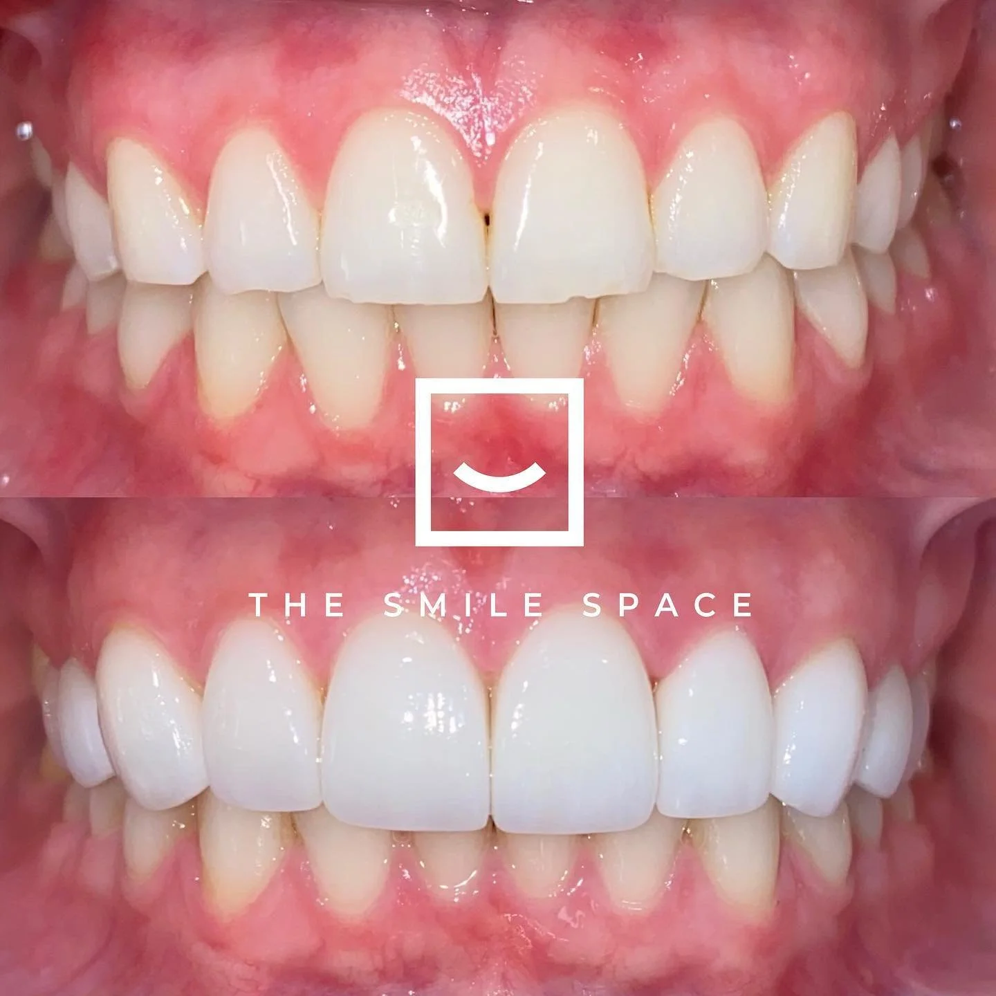 10 upper porcelain veneers to rejuvenate this smile. 
.
.
.
#seattledentist #seattleorthodontist #belltowndentist #belltownorthodontist #dentist #orthodontist #dentistry #orthodontics #dentaloffice #veneers #dentalveneers #porcelainveneers #dental #c
