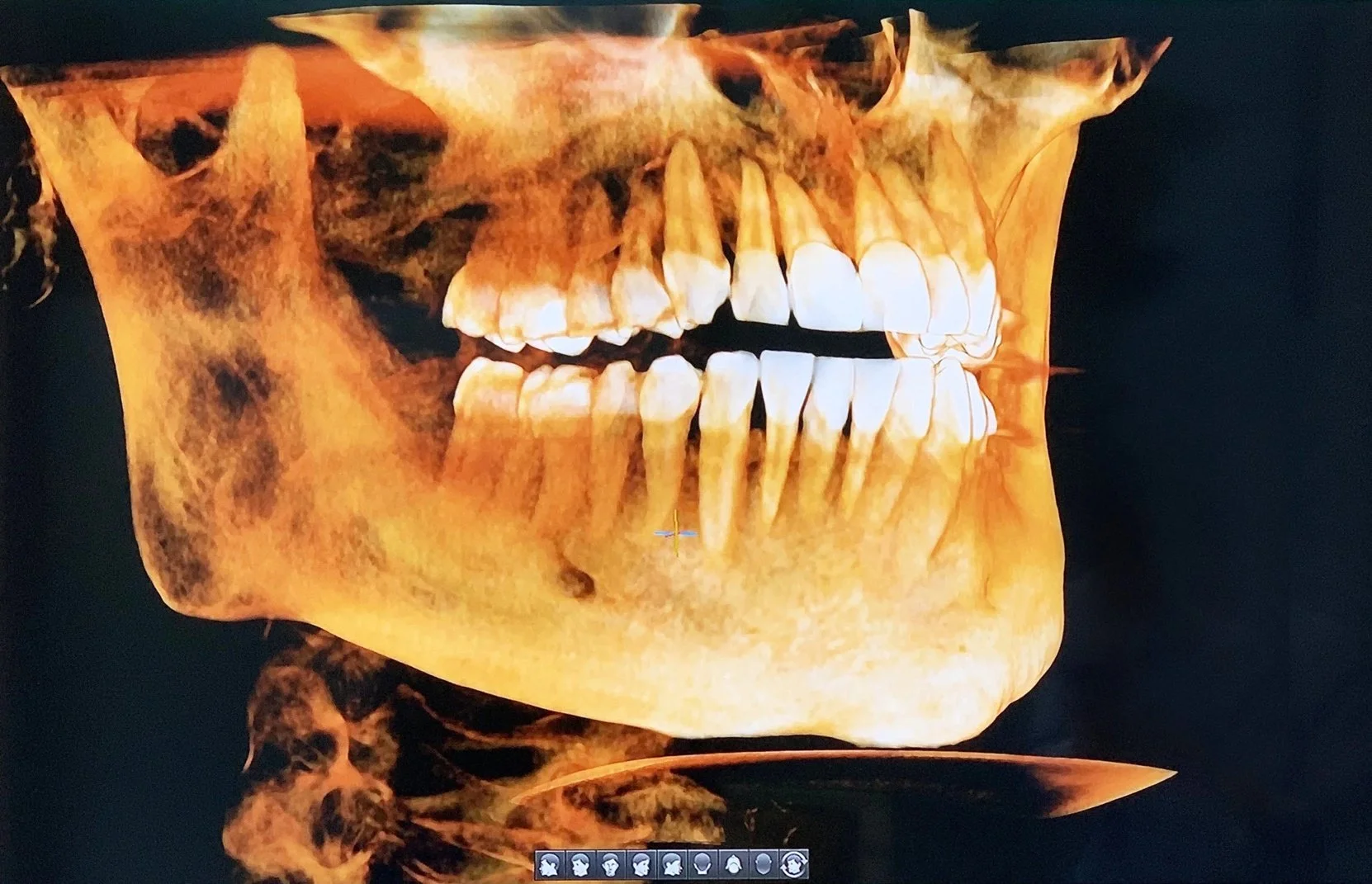 Three-dimensional CBCT scan displayed in dental imaging software for comprehensive diagnosis and treatment planning at The Smile Space.
