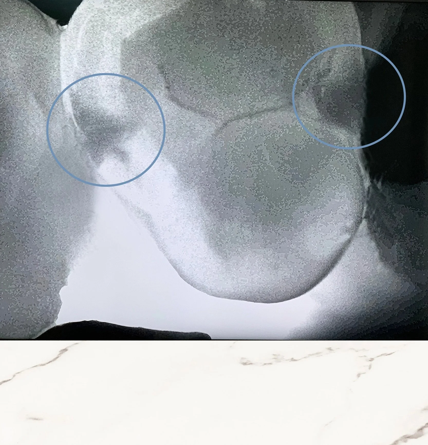 CariVu near-infrared image showing cavities on the mesial and distal surfaces between adjacent teeth, helping detect early interproximal decay at The Smile Space.