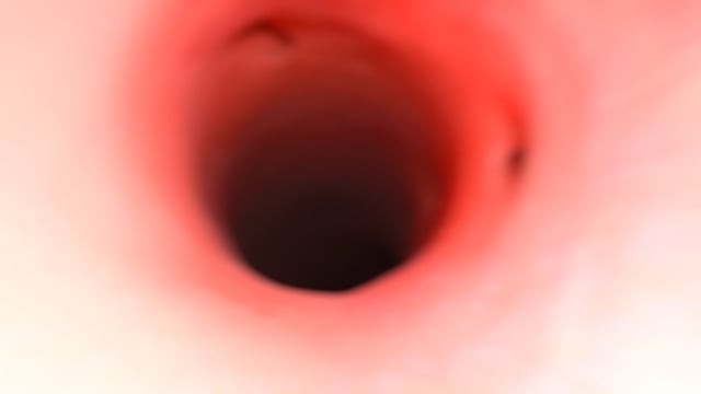 A fly-through rendering of the aorta, just distal to the arch vessels, moving retrograde toward the aorta, then entering the left coronary artery.