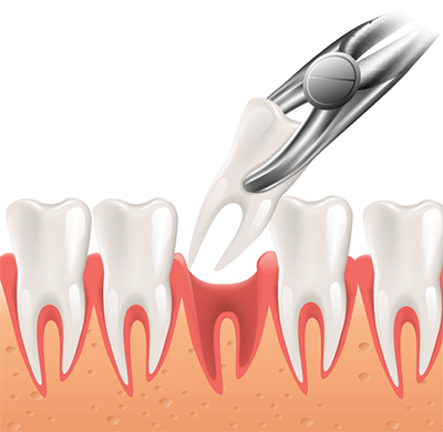Tooth Extraction.png