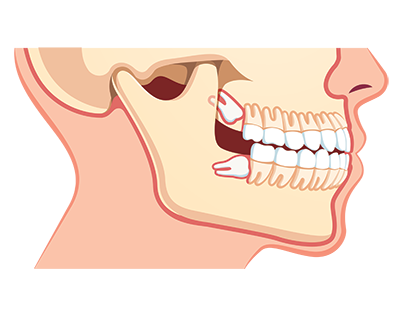 Wisdom Teeth.png