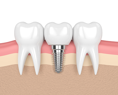 Implant Restoration.png