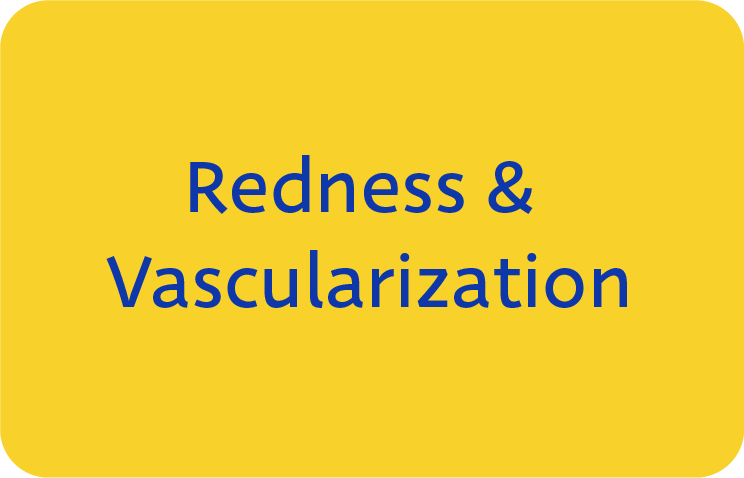 MGD Symptom 3: Redness and Vascularization