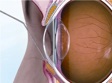 In the Maskin Probing Protocol, an eye doctor uses a small probe to enter the Meibomian Gland duct. By entering the duct with the shortest and stiffest probe first, your doctor can penetrate strictures on the surface of the duct and within the first millimeter of the gland. These strictures are created by periductal fibroses, or scar tissue, around the gland, which squeeze the duct and alter the needed channel through which oil flows. Without the proper flow of oil to the eye, the gland becomes progressively blocked, and the patient can feel increasing inflammation, tenderness in the lid, and additional symptoms associated with MGD and dry eye.