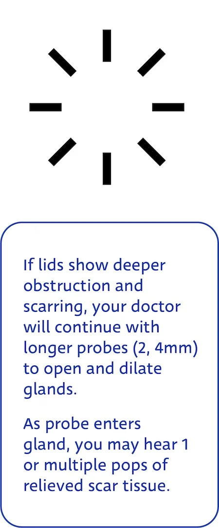 Maskin Meibomian Gland Probing Step 3: If lid shows deeper obstruction, doctor will continue with longer probes of 2mm and 4mm to open and dilate glands. Relieved scar tissue may make one or several popping noises as pressure is equilibrated and meibum flow reenabled.