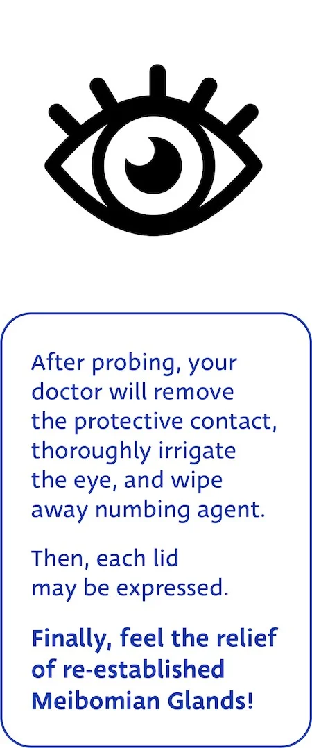 Maskin Meibomian Gland Probing Step 4: Doctor will remove protective contact, wipe away numbing agent and irrigate eye, then express each probed lid. Finally feel the relief of reestablished Meibomian Glands as an essential piece of you dry eye treatment plan!