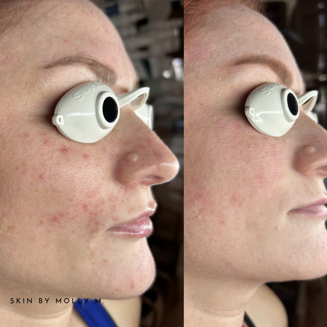 Adult Acne Treatment in Granite Bay, CA: Why Your Home Skincare Routine Matters More Than Your Facial