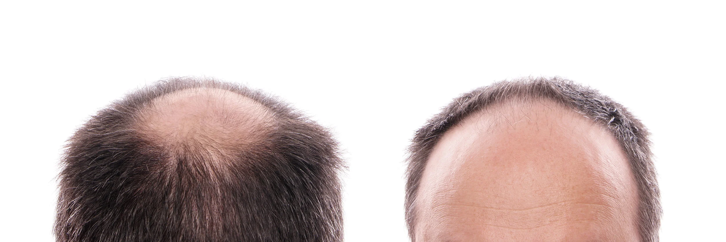Male Hair Loss Texas Hair Restoration Center