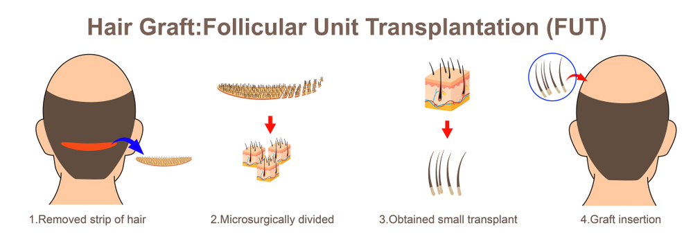 Hair Transplant Graft Chart