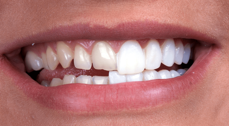 porcelain veneers