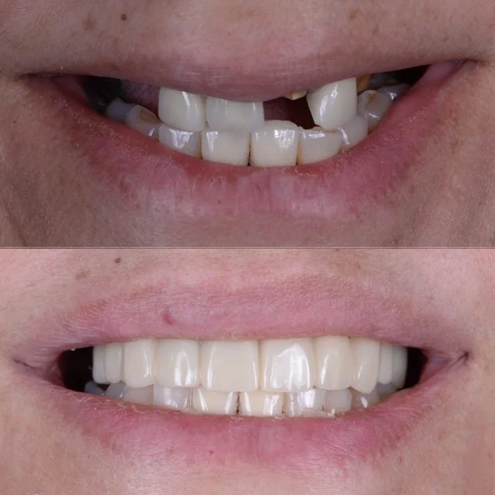 Hypodontia Before And After