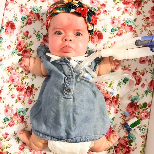 Paisley Life With Thanatophoric Dysplasia Macy Gilson