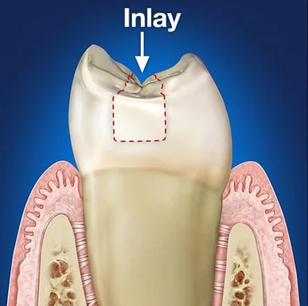 inlay-and-onlay copy.jpg