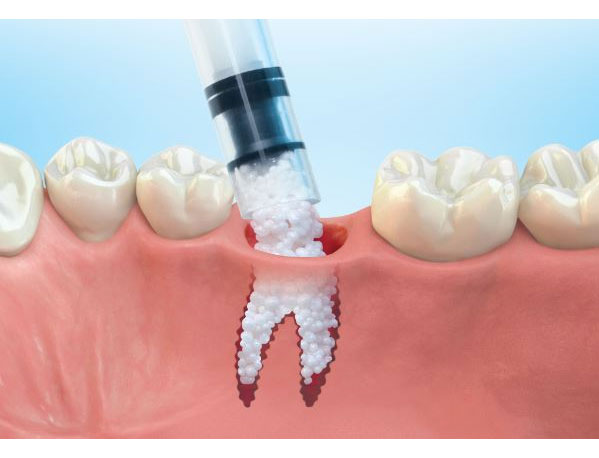 Bone Grafting Ridge Augmentation Hamilton H Le D M D F A C P bone-grafting-ridge-augmentation-hamilton-h-le-d-m-d-f-a-c-p
