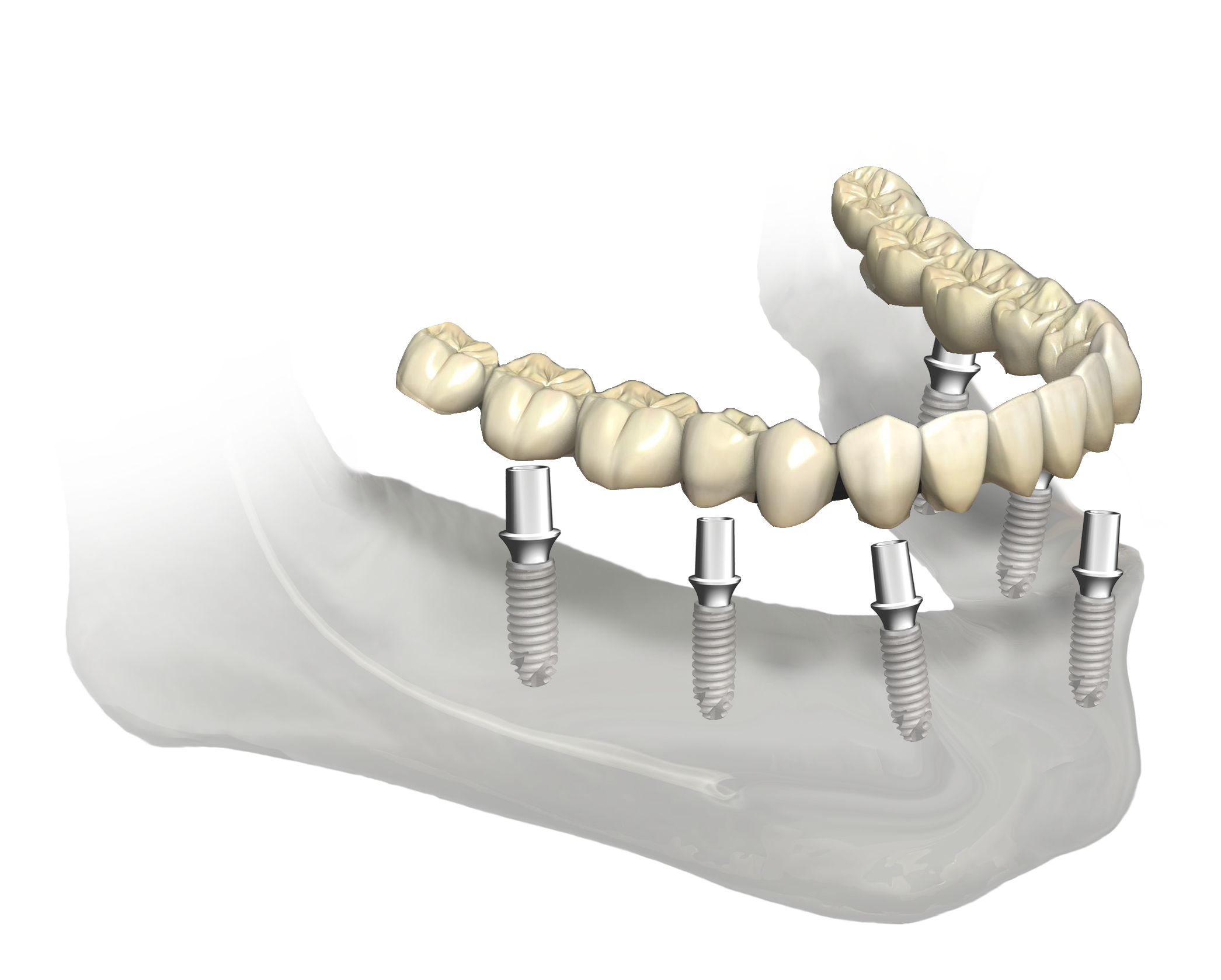 mandibule-totale-scellé-M.png
