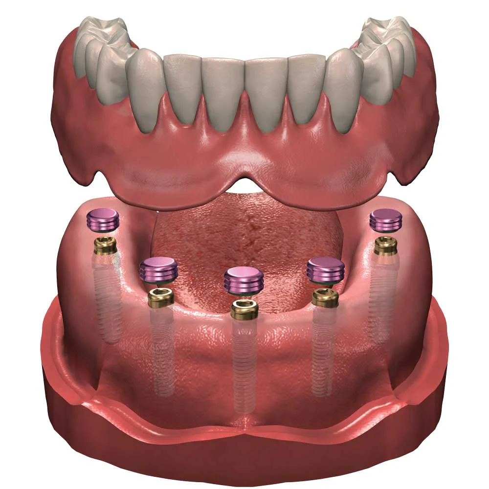 implants-multiples-1000.jpg