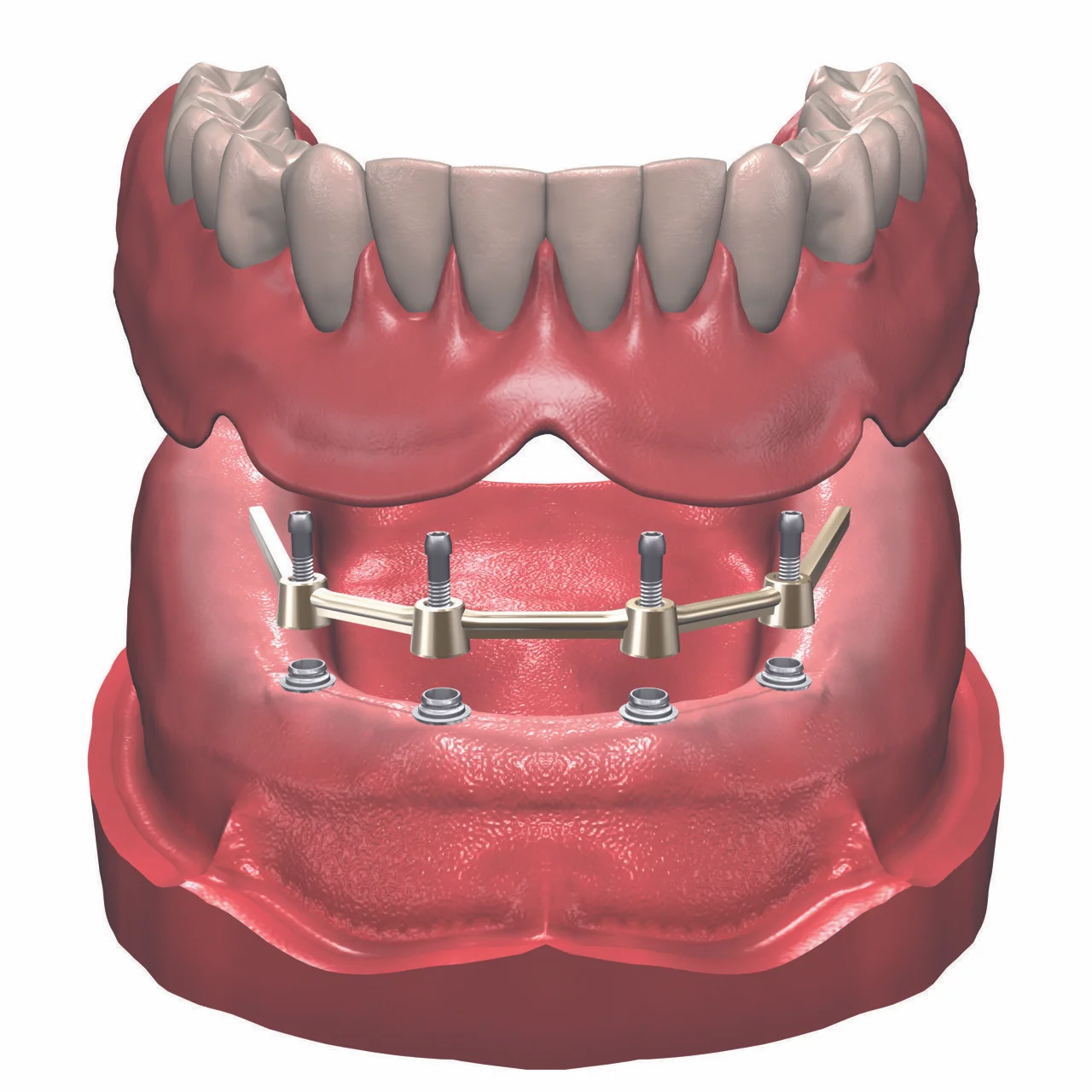 FullArchBarOverdentureon4-6implants.jpg