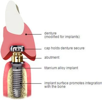 Cross sectional view of the locator abutment complex. The male housing is embedded in the denture, the abutment engages the implant in the bone and the two engage one another to help stabilize the denture.