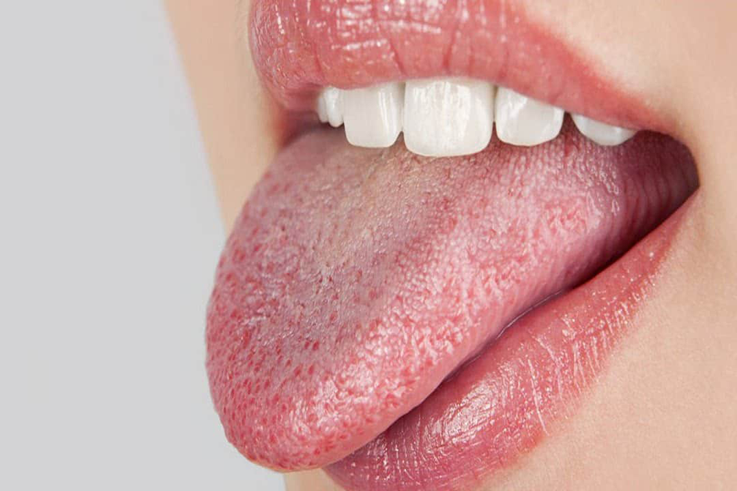 Xerostomia Caries And