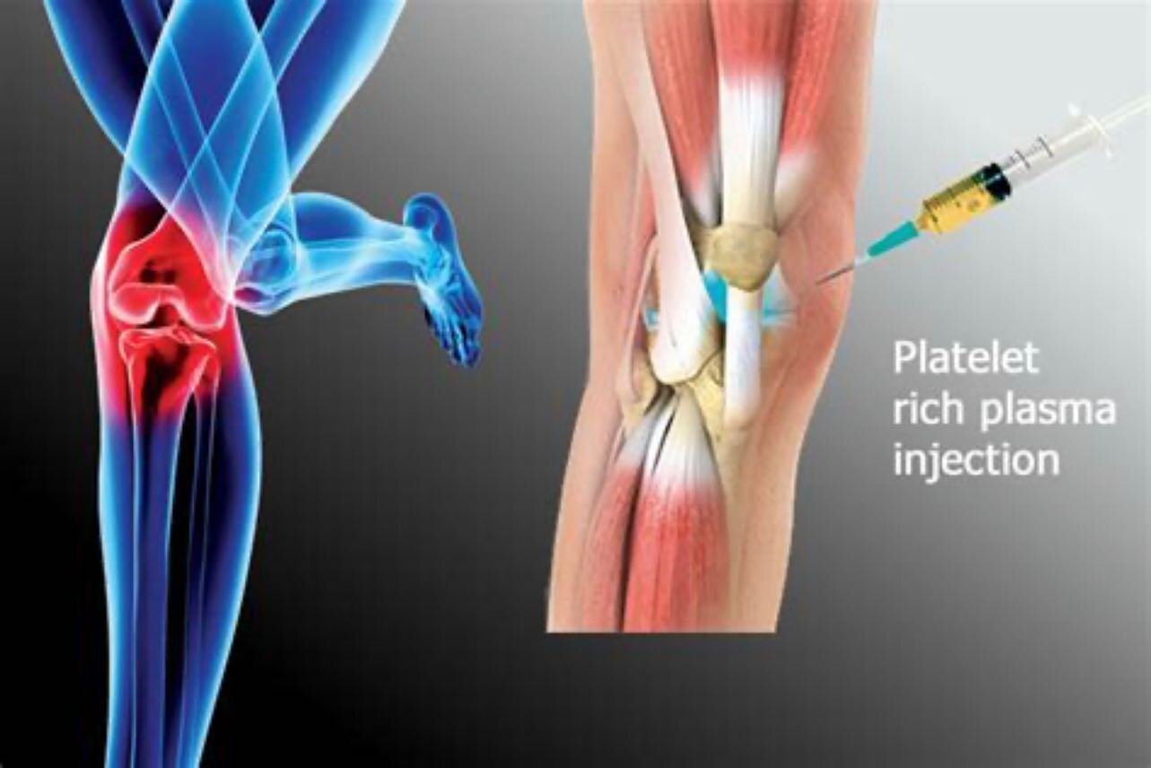BridgeHealth now offers platelet-rich plasma (PRP) with our very own orthopaedic surgeon, Dr. B!

Used to treat a variety of musculoskeletal issues, PRP uses the patient&rsquo;s own blood cells to accelerate healing. Here are some of the common uses 